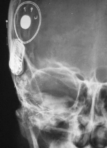 Image result for Split Electrode Array