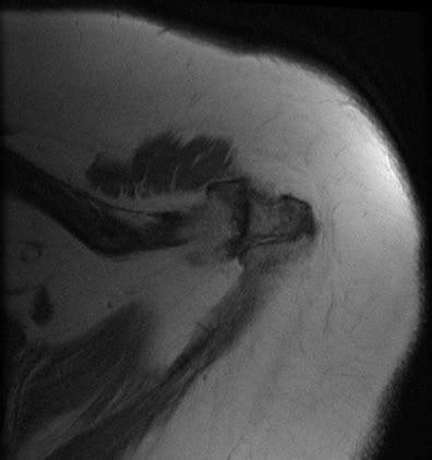 Image result for OS Acromiale Type 2