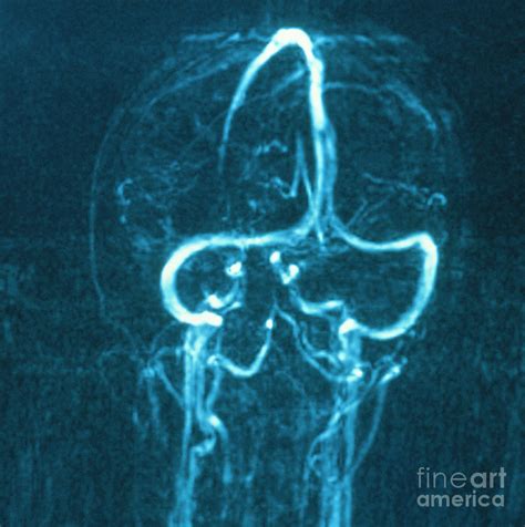 Toradh íomhá ar Neuroradiology Brain Scan