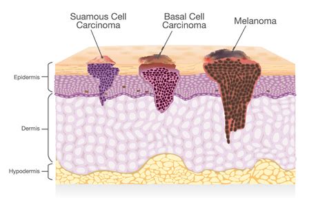 Image result for Types of Skin Cancer