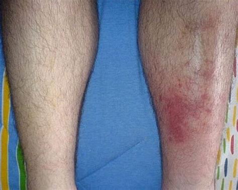 Image result for Left Leg Cellulitis
