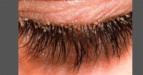 Image result for Demodex Blepharitis Symptoms