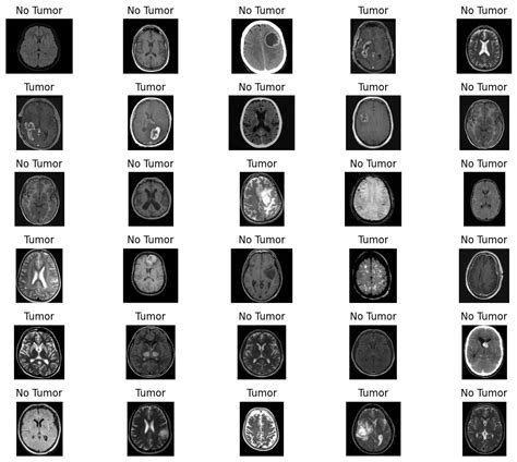 Résultat d’images pour Brain Tumor Detection Using Deep Learning