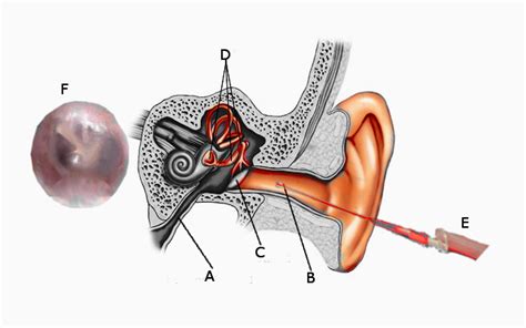 Toradh íomhá ar Tympanocentesis