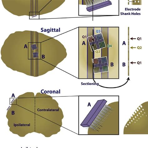 Image result for Utal Electrode Array