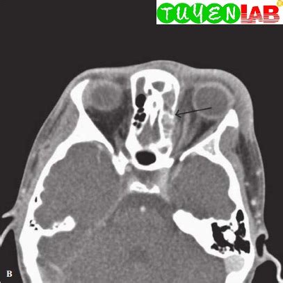 Afbeeldingsresultaten voor CT Scan with Contrast for Orbital Cellulitis