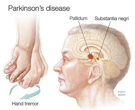 Mayo Clinic Parkinson's Disease に対する画像結果