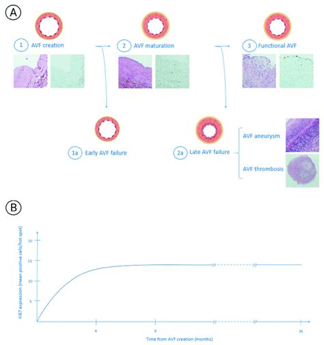 Image result for AVF Formation