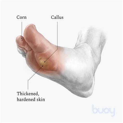Image result for Pictures of Corns and Calluses