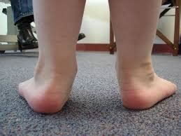 Image result for Pes Planovalgus