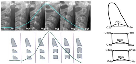 Afbeeldingsresultaten voor Cervical Maturation Stage