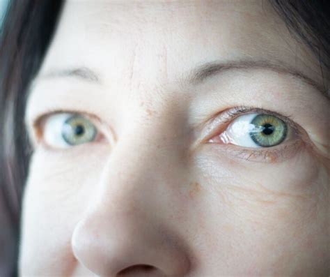 Image result for Exopthalmia