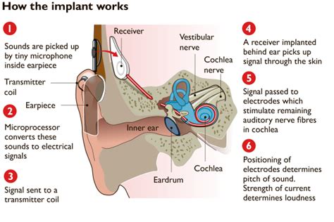 Image result for Cochlear Implant Ear Diagram