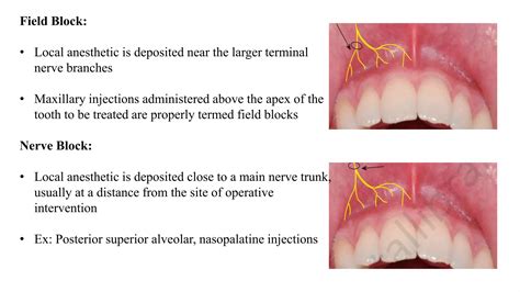 Image result for Maxillary Nerve Block