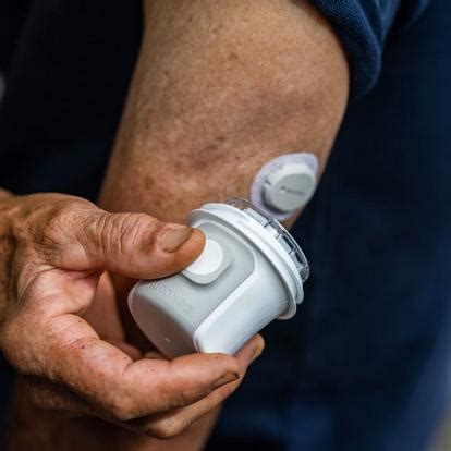 Apply Dexcom Sensor എന്നതിനുള്ള ഇമേജ് ഫലം