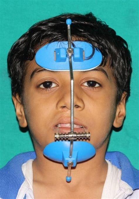 Image result for Maxillary Protraction