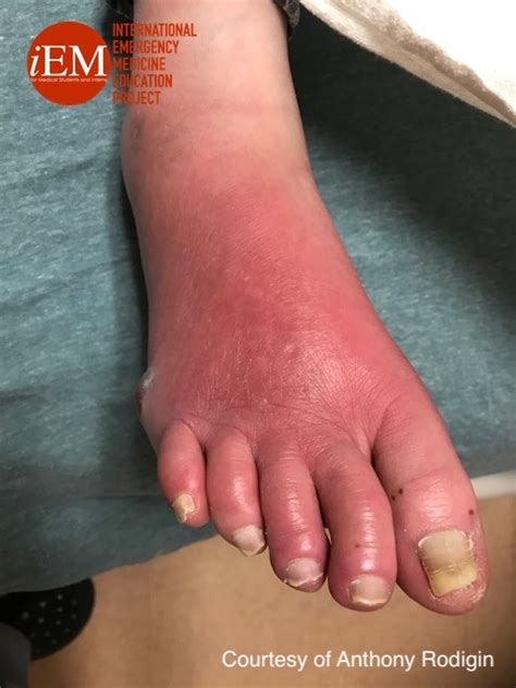 Résultat d’images pour Cellulitis On Foot and Ankle