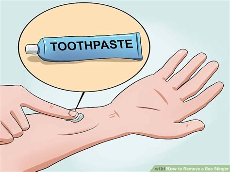 Image result for How to Remove a Bee Stinger