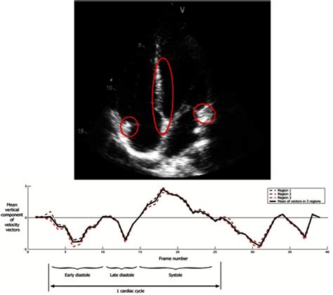 Toradh íomhá ar Speckle Tracking Algorithm