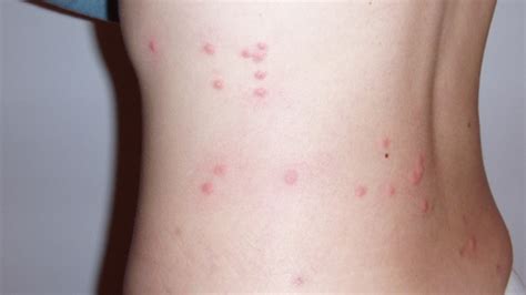 Image result for Flea Bite Problem