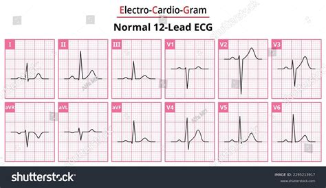 Afbeeldingsresultaten voor Normal ECG Trace