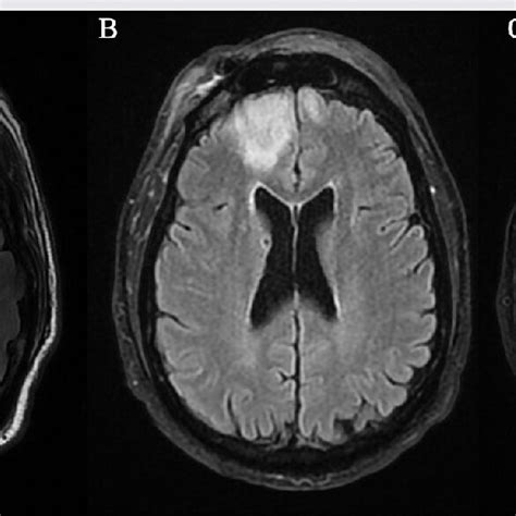 Afbeeldingsresultaten voor Frontal Cortex MRI Normal Side View
