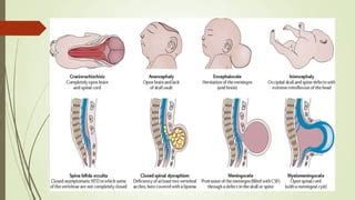 How Common Are Neural Tube Defects に対する画像結果