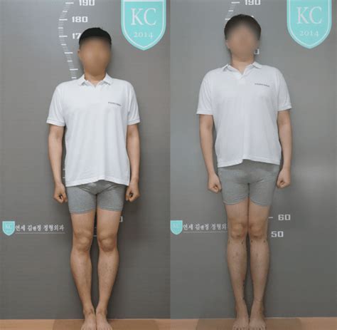 Image result for Dwarfism Leg Extensions