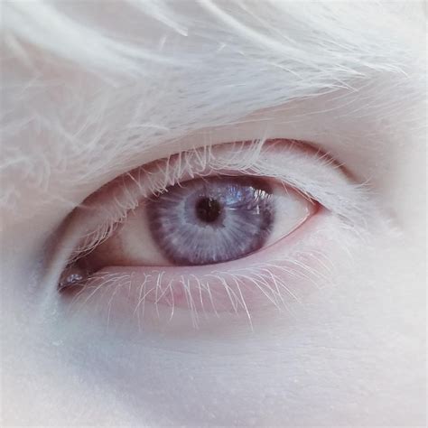 Light Blue Eyes Albinism に対する画像結果