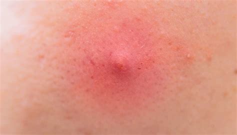 Image result for Painful Pimple Under Armpit