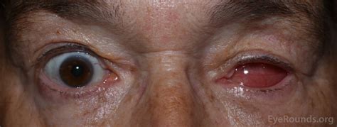 Image result for Eye Pops Out of Socket