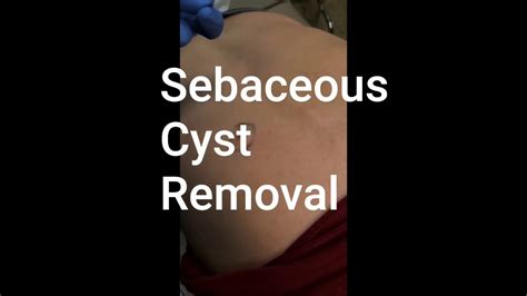 DIY Remove Sebaceous Cyst に対する画像結果