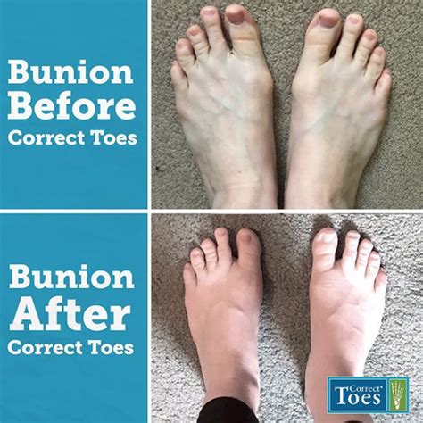 How to Set Toe Alignment に対する画像結果