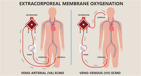 Image result for ECMO Patient