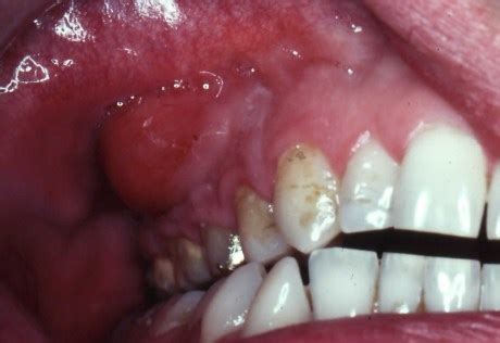 Image result for Abscess Tooth
