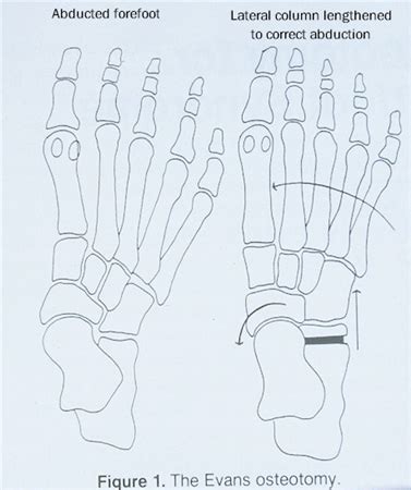 Image result for Pes Planovalgus