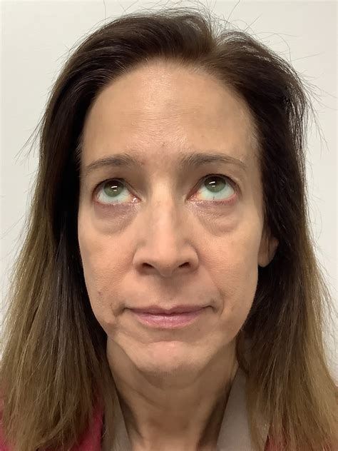 Image result for Botox Wrinkle Cream