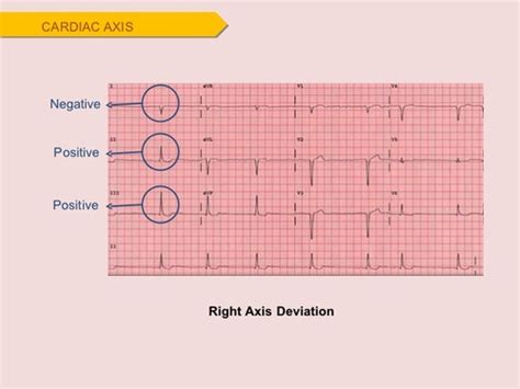 Image result for Positive and Negative Deflection ECG