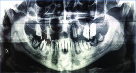 Image result for Maxillary Cyst