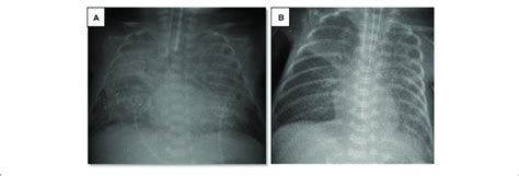 Image result for Ards X-ray