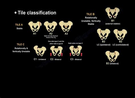 Afbeeldingsresultaten voor Pelvic Fracture Types