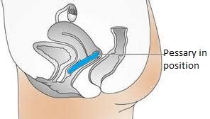 Image result for How to Put in a Pessary Ring