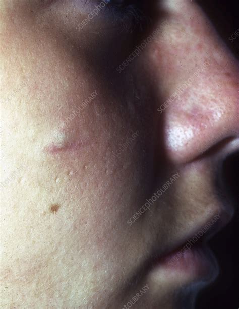 Lancing a Sebaceous Cyst に対する画像結果