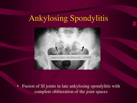 Image result for Ulcerative Colitis CT Scan