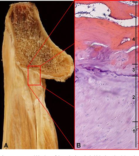 Image result for Hamstring Rupture