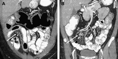 Image result for CT Enterography