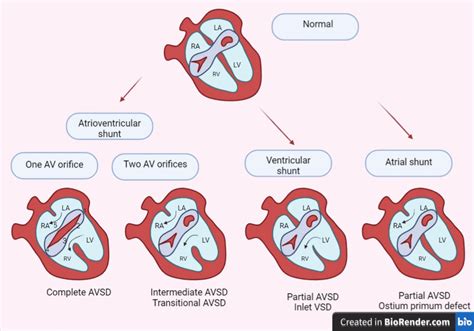 Toradh íomhá ar Atrial Septal Defect Classification