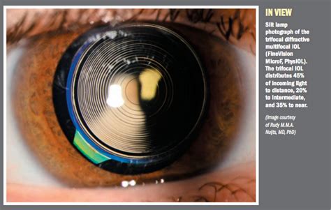 Image result for Multifocal IOL View