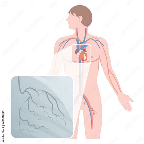 Image result for Angiogram CARF