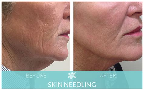 Toradh íomhá ar Before and After Needling Procedures